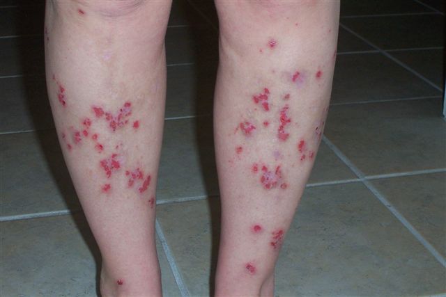 File:Morgellons-disease-feet1.jpg