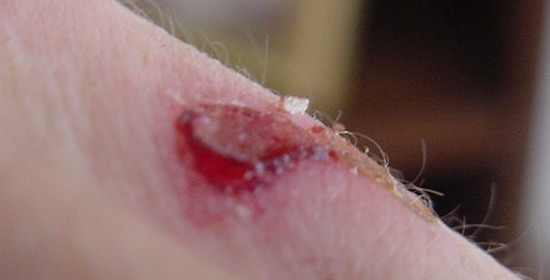 File:Morbo-di-morgellons.jpg