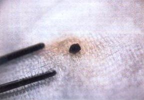 File:Implant removed.jpg
