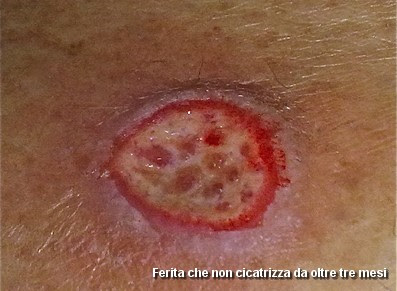 File:Morgellons-paziente-due-small.jpg