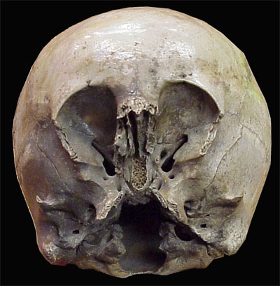 File:Starchild skull.jpg
