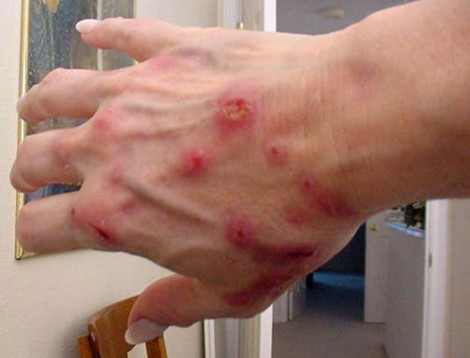 File:Sindrome-morgellons.jpg