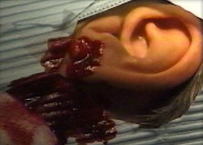 File:Implant8.jpeg