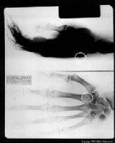 File:Implant xray2.jpg