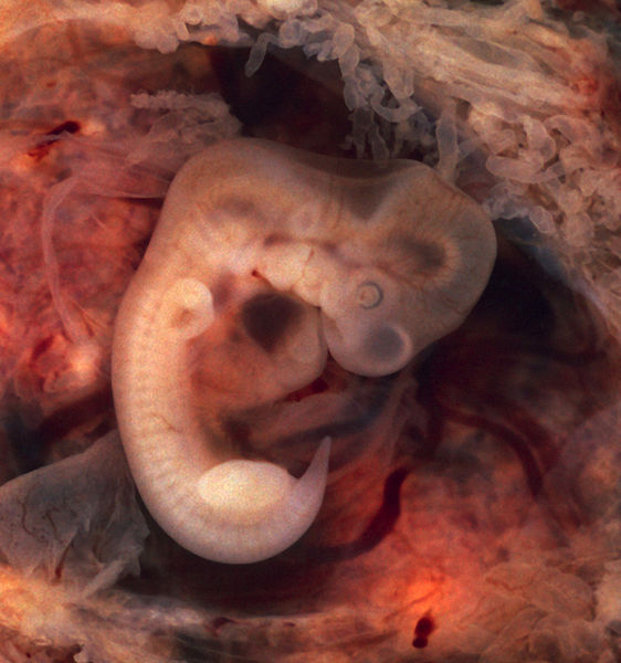 File:562px-Tubal Pregnancy with embryo.jpg