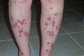 Morgellons-disease-feet1.jpg