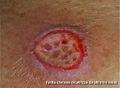 Morgellons-paziente-due-small.jpg